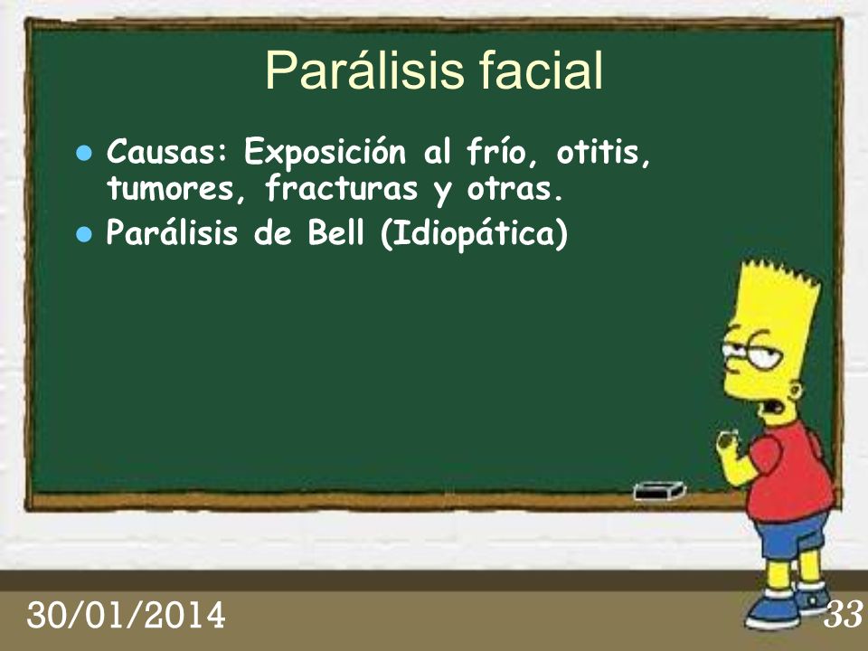 Parálisis facial Causas: Exposición al frío, otitis, tumores, fracturas y otras. Parálisis de Bell (Idiopática)