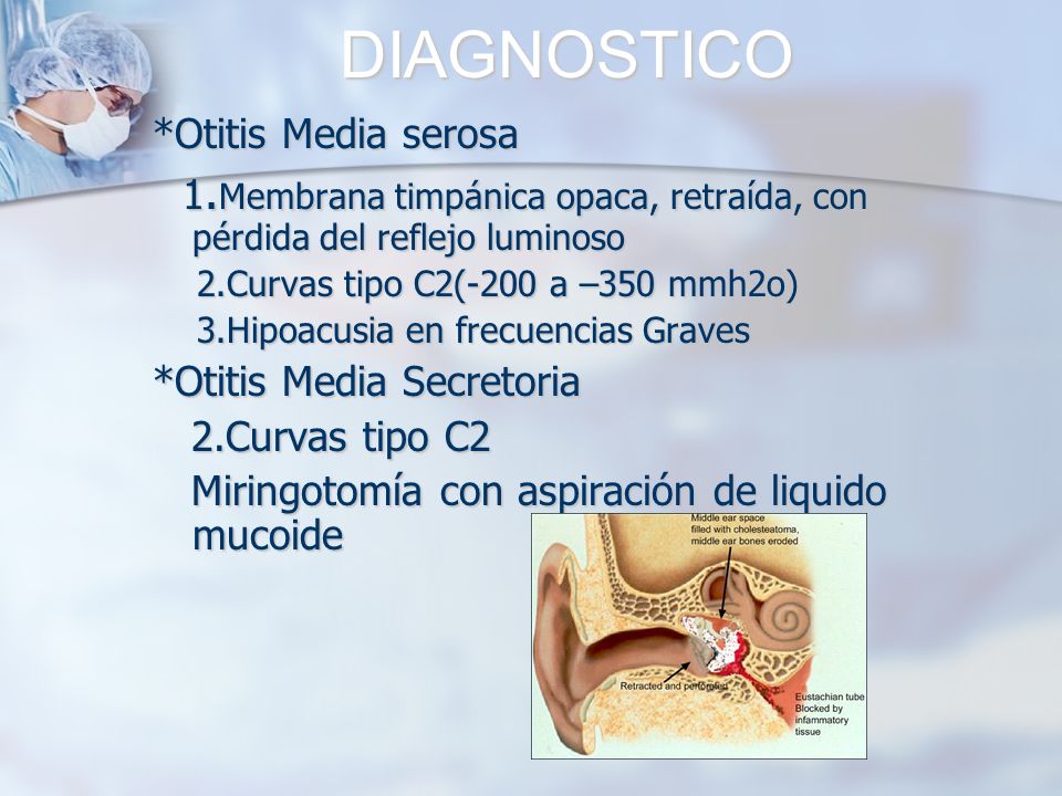 DIAGNOSTICO *Otitis Media serosa. 1.Membrana timpánica opaca, retraída, con pérdida del reflejo luminoso.