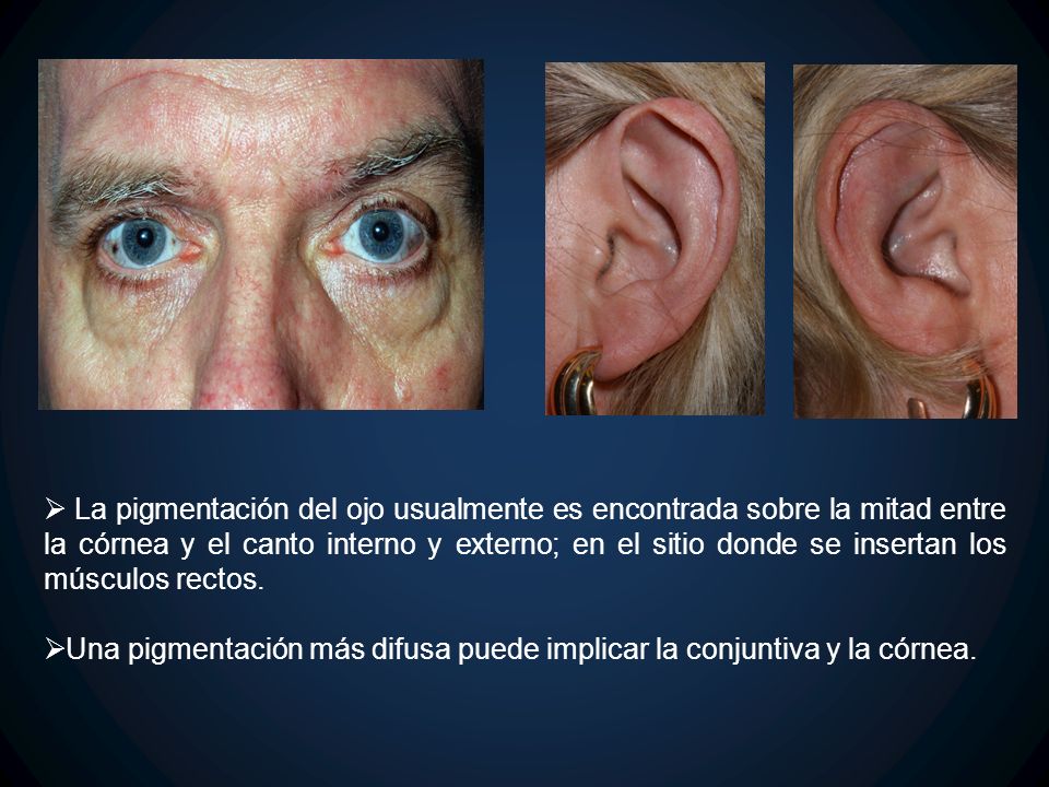 La pigmentación del ojo usualmente es encontrada sobre la mitad entre la córnea y el canto interno y externo; en el sitio donde se insertan los músculos rectos.