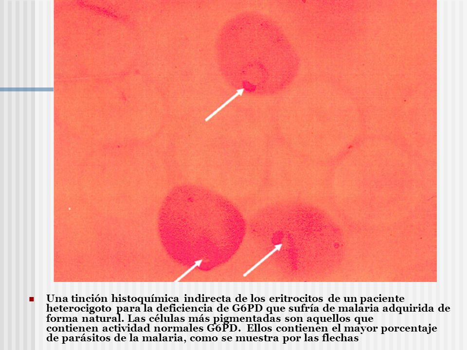 Una tinción histoquímica indirecta de los eritrocitos de un paciente heterocigoto para la deficiencia de G6PD que sufría de malaria adquirida de forma natural. Las células más pigmentadas son aquellos que contienen actividad normales G6PD. Ellos contienen el mayor porcentaje de parásitos de la malaria, como se muestra por las flechas