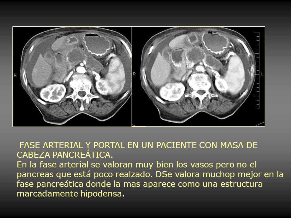 FASE ARTERIAL Y PORTAL EN UN PACIENTE CON MASA DE CABEZA PANCREÁTICA.