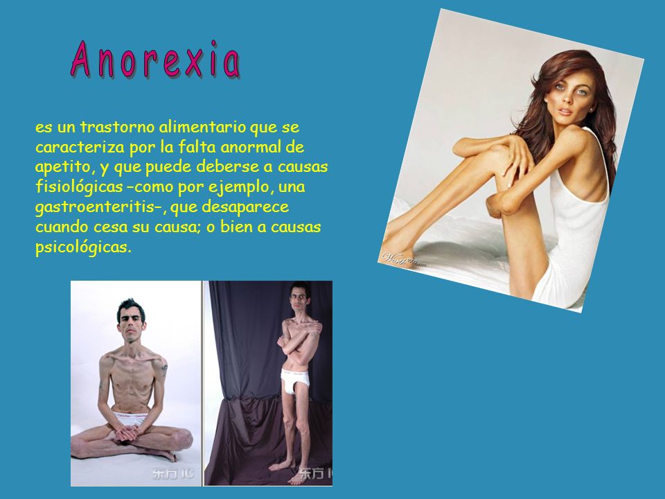 Anorexia