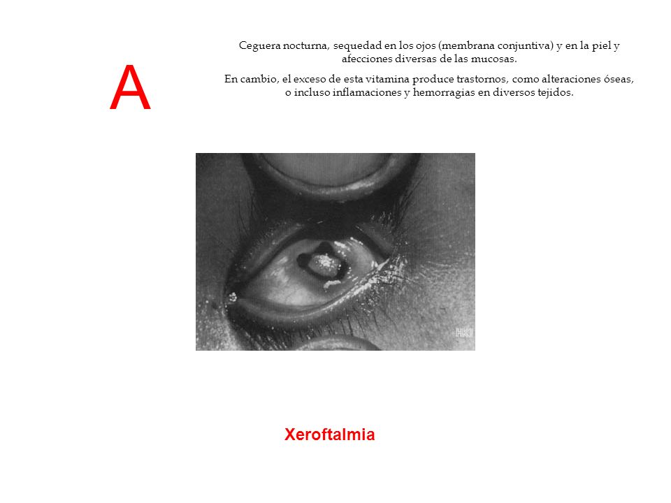 Ceguera nocturna, sequedad en los ojos (membrana conjuntiva) y en la piel y afecciones diversas de las mucosas.