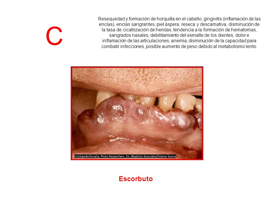 Resequedad y formación de horquilla en el cabello, gingivitis (inflamación de las encías), encías sangrantes, piel áspera, reseca y descamativa, disminución de la tasa de cicatrización de heridas, tendencia a la formación de hematomas, sangrados nasales, debilitamiento del esmalte de los dientes, dolor e inflamación de las articulaciones, anemia, disminución de la capacidad para combatir infecciones, posible aumento de peso debido al metabolismo lento.