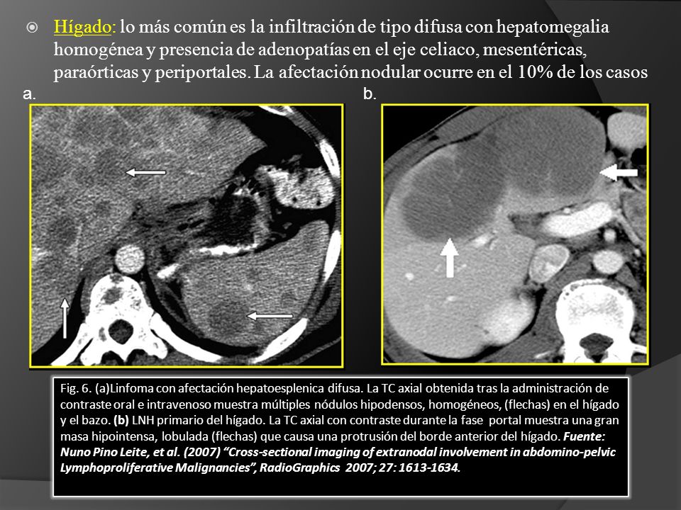 Hígado: lo más común es la infiltración de tipo difusa con hepatomegalia homogénea y presencia de adenopatías en el eje celiaco, mesentéricas, paraórticas y periportales. La afectación nodular ocurre en el 10% de los casos