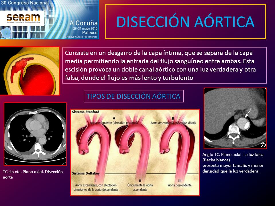 DISECCIÓN AÓRTICA TIPOS DE DISECCIÓN AÓRTICA