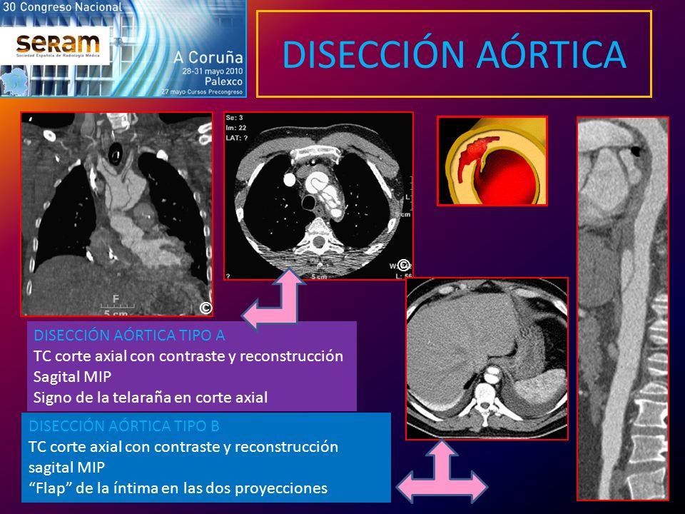 DISECCIÓN AÓRTICA © © DISECCIÓN AÓRTICA TIPO A