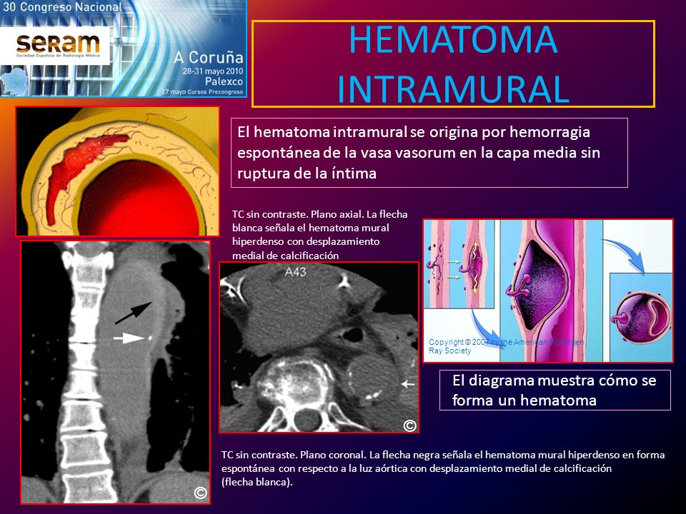 HEMATOMA INTRAMURAL El hematoma intramural se origina por hemorragia espontánea de la vasa vasorum en la capa media sin ruptura de la íntima.