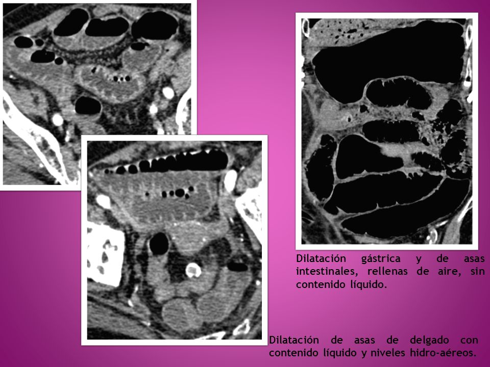Dilatación gástrica y de asas intestinales, rellenas de aire, sin contenido líquido.