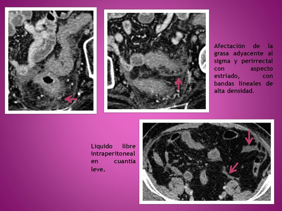 Afectación de la grasa adyacente al sigma y perirrectal con aspecto estriado, con bandas lineales de alta densidad.