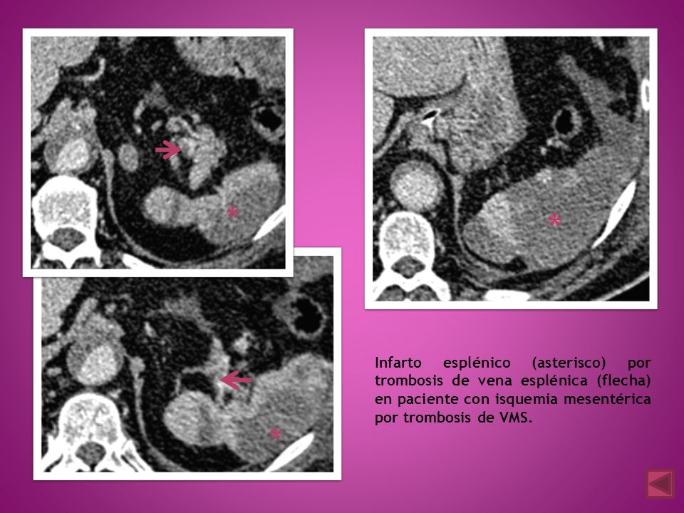 * * Infarto esplénico (asterisco) por trombosis de vena esplénica (flecha) en paciente con isquemia mesentérica por trombosis de VMS.