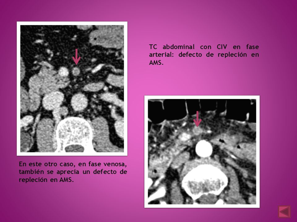 TC abdominal con CIV en fase arterial: defecto de repleción en AMS.