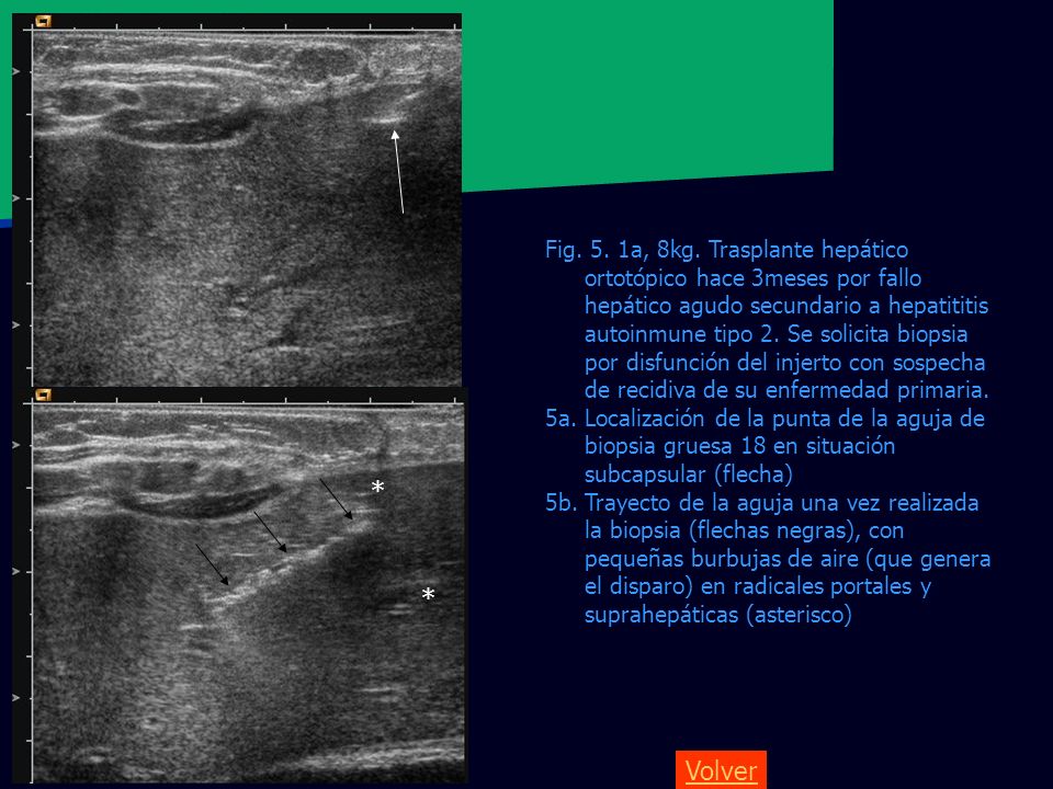 Fig. 5. 1a, 8kg. Trasplante hepático ortotópico hace 3meses por fallo hepático agudo secundario a hepatititis autoinmune tipo 2. Se solicita biopsia por disfunción del injerto con sospecha de recidiva de su enfermedad primaria.