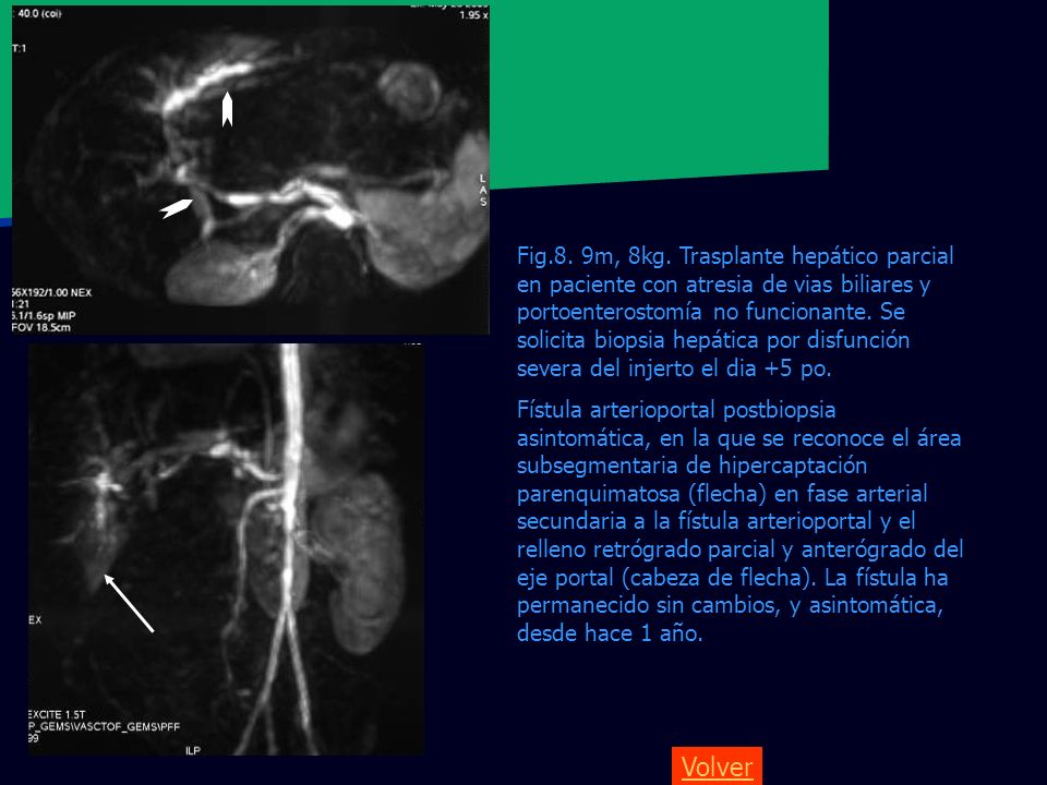 Fig.8. 9m, 8kg. Trasplante hepático parcial en paciente con atresia de vias biliares y portoenterostomía no funcionante. Se solicita biopsia hepática por disfunción severa del injerto el dia +5 po.