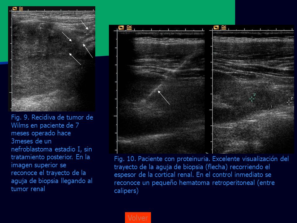 Fig. 9. Recidiva de tumor de Wilms en paciente de 7 meses operado hace 3meses de un nefroblastoma estadio I, sin tratamiento posterior. En la imagen superior se reconoce el trayecto de la aguja de biopsia llegando al tumor renal