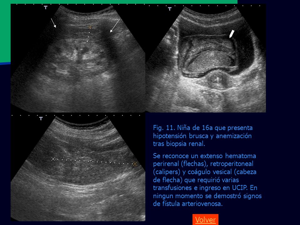 Fig. 11. Niña de 16a que presenta hipotensión brusca y anemización tras biopsia renal.