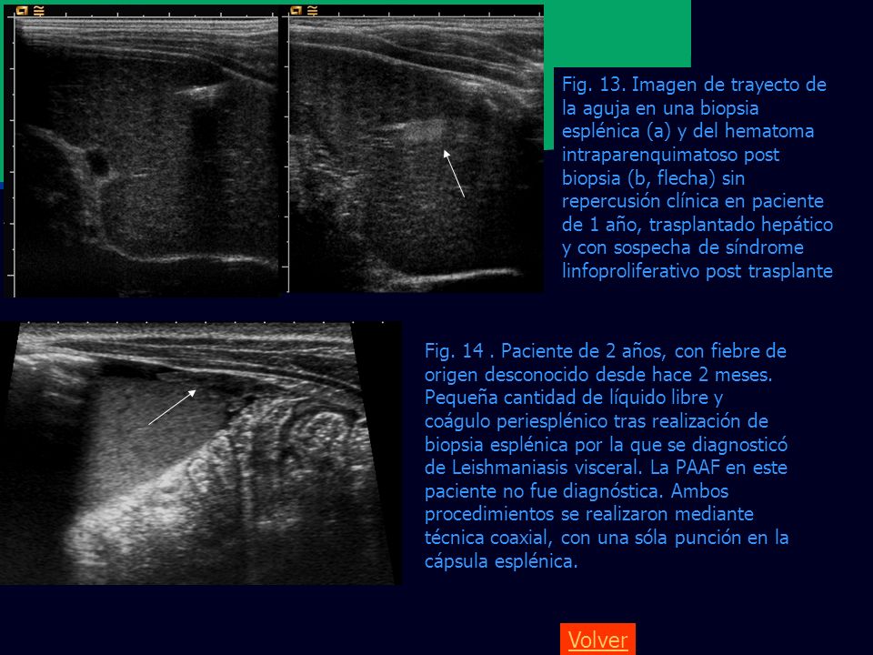 Fig. 13. Imagen de trayecto de la aguja en una biopsia esplénica (a) y del hematoma intraparenquimatoso post biopsia (b, flecha) sin repercusión clínica en paciente de 1 año, trasplantado hepático y con sospecha de síndrome linfoproliferativo post trasplante