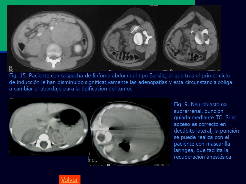 Fig. 15. Paciente con sospecha de linfoma abdominal tipo Burkitt, al que tras el primer ciclo de inducción le han disminuído significativamente las adenopatías y esta circunstancia obliga a cambiar el abordaje para la tipificación del tumor.