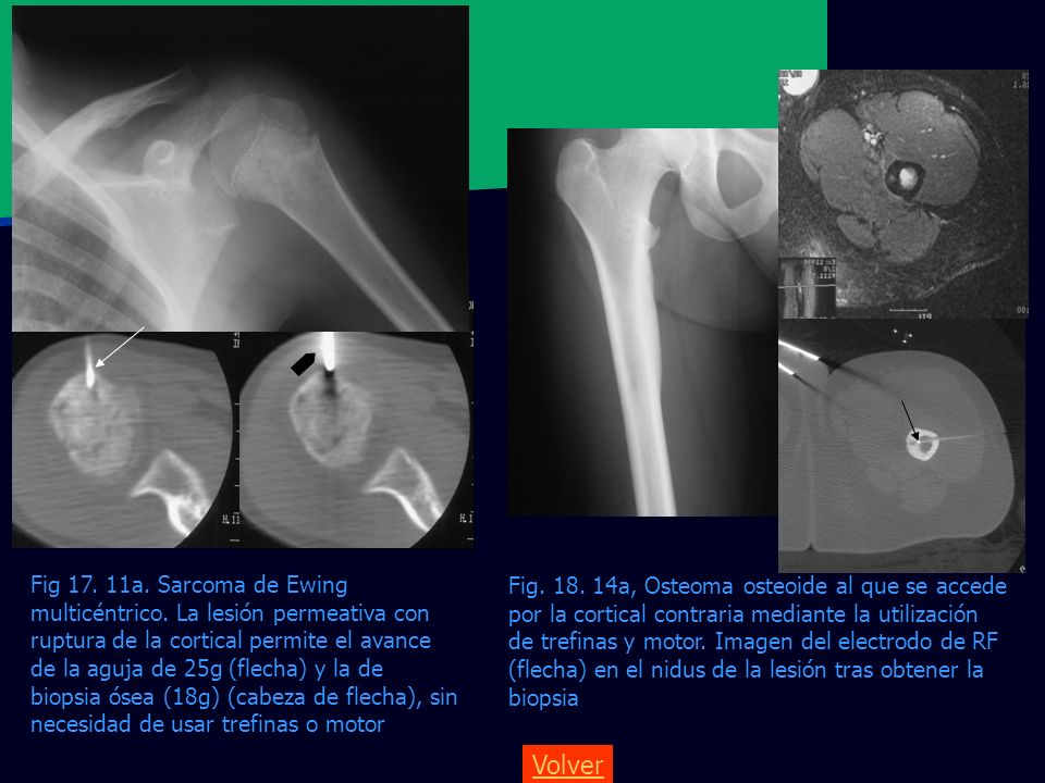 Fig a, Osteoma osteoide al que se accede por la cortical contraria mediante la utilización de trefinas y motor. Imagen del electrodo de RF (flecha) en el nidus de la lesión tras obtener la biopsia