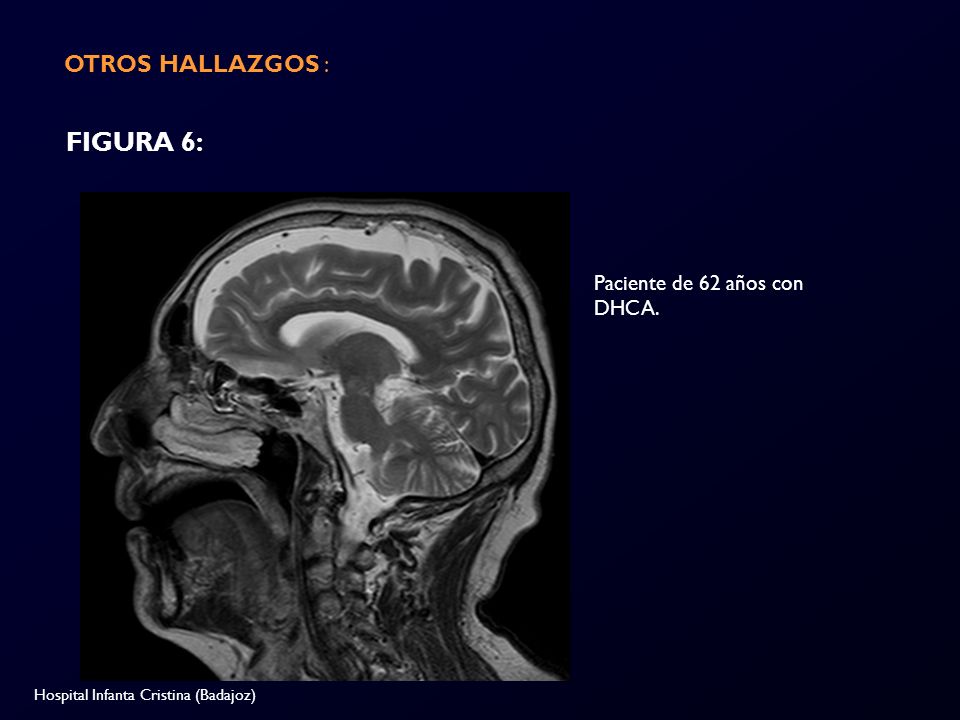 FIGURA 6: OTROS HALLAZGOS : Paciente de 62 años con DHCA.