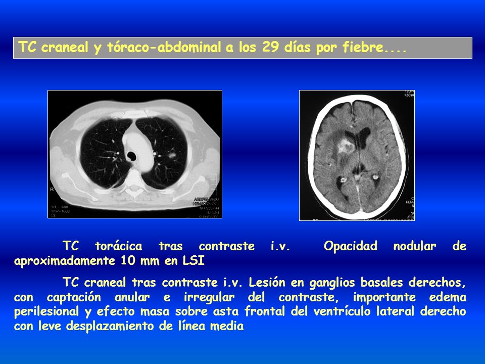 TC craneal y tóraco-abdominal a los 29 días por fiebre....