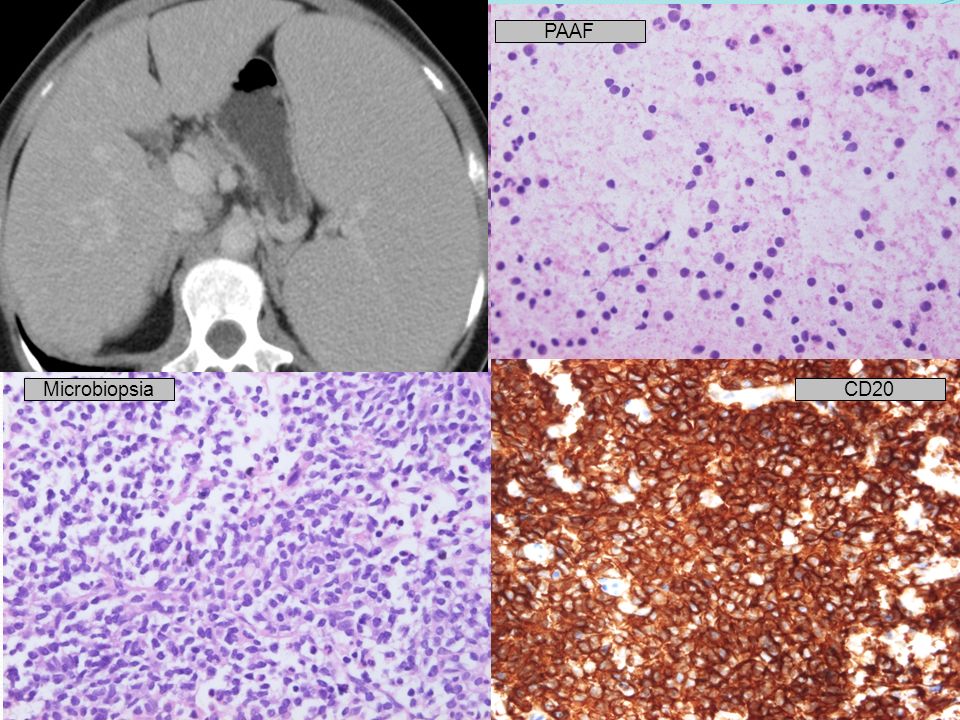 PAAF Microbiopsia. CD20. CASO 19: PAAF: proliferación monomorfa de células linfoides de pequeño tamaño.