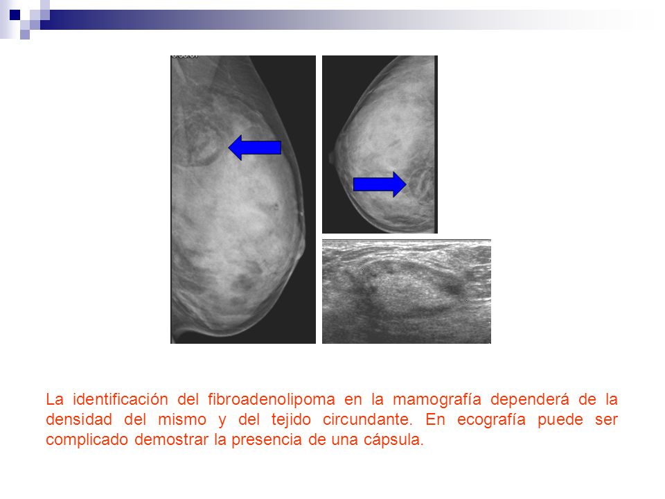 La identificación del fibroadenolipoma en la mamografía dependerá de la densidad del mismo y del tejido circundante.