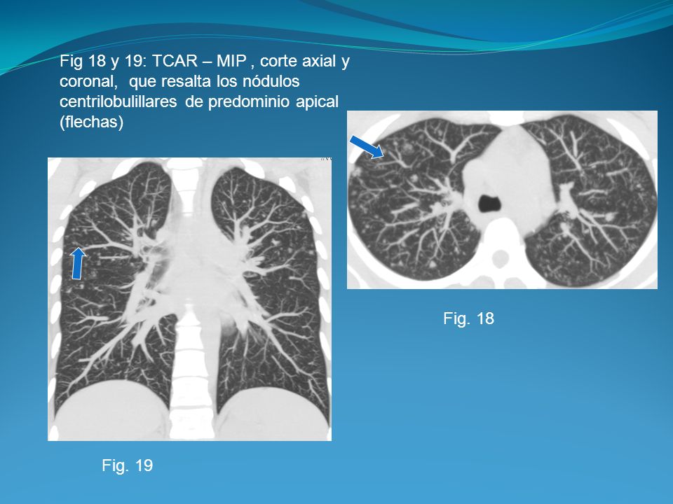 Fig 18 y 19: TCAR – MIP , corte axial y coronal, que resalta los nódulos centrilobulillares de predominio apical (flechas)
