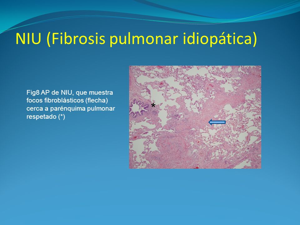 NIU (Fibrosis pulmonar idiopática)
