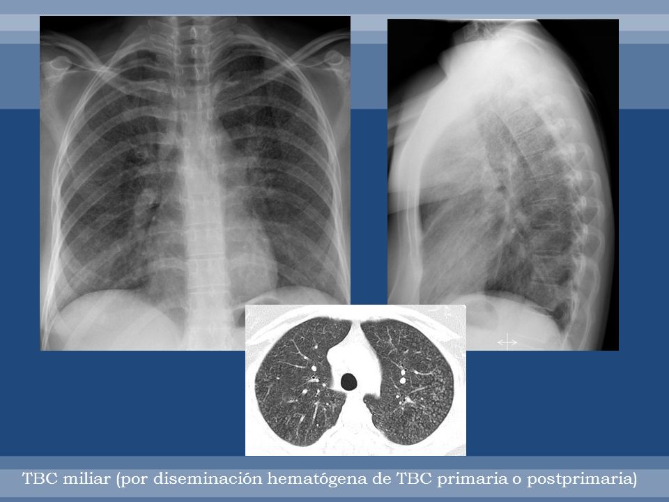 TBC MILIAR: diseminación hematógena de tbc rpimaria o postprimaria