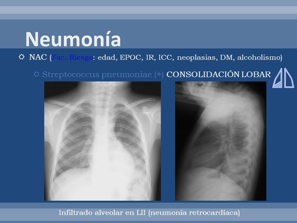 Neumonía NAC (Fac. Riesgo: edad, EPOC, IR, ICC, neoplasias, DM, alcoholismo) Streptococcus pneumoniae (+) CONSOLIDACIÓN LOBAR.
