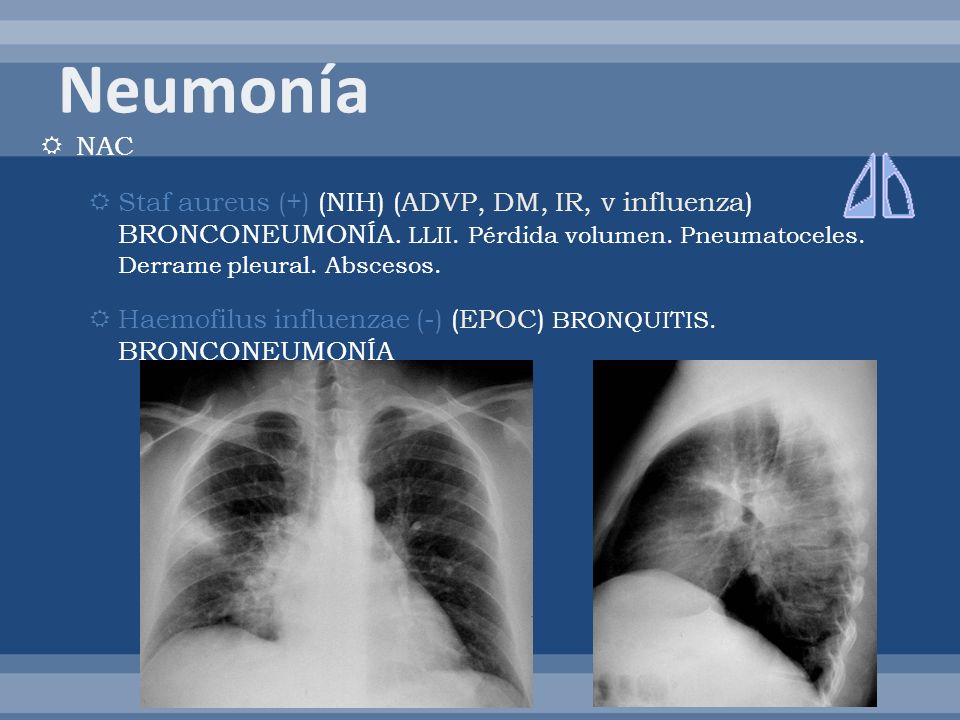 Neumonía NAC. Staf aureus (+) (NIH) (ADVP, DM, IR, v influenza) BRONCONEUMONÍA. LLII. Pérdida volumen. Pneumatoceles. Derrame pleural. Abscesos.