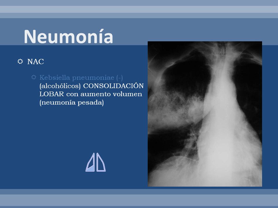 Neumonía NAC. Kebsiella pneumoniae (-) (alcohólicos) CONSOLIDACIÓN LOBAR con aumento volumen (neumonía pesada)