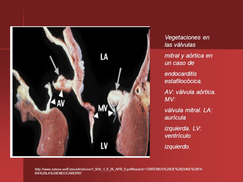 Vegetaciones en las válvulas mitral y aórtica en un caso de