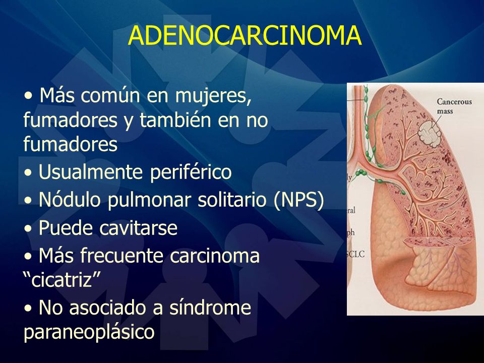 ADENOCARCINOMA Más común en mujeres, fumadores y también en no fumadores. Usualmente periférico. Nódulo pulmonar solitario (NPS)