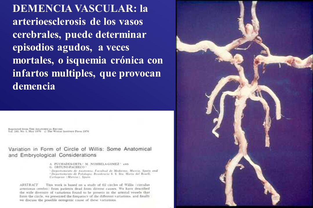 DEMENCIA VASCULAR: la arterioesclerosis de los vasos cerebrales, puede determinar episodios agudos, a veces mortales, o isquemia crónica con infartos multiples, que provocan demencia