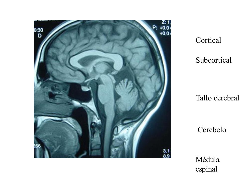 Cortical Subcortical Tallo cerebral Cerebelo Médula espinal