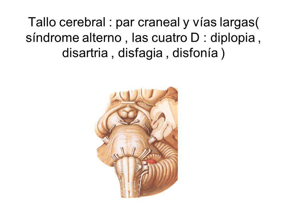 Tallo cerebral : par craneal y vías largas( síndrome alterno , las cuatro D : diplopia , disartria , disfagia , disfonía )