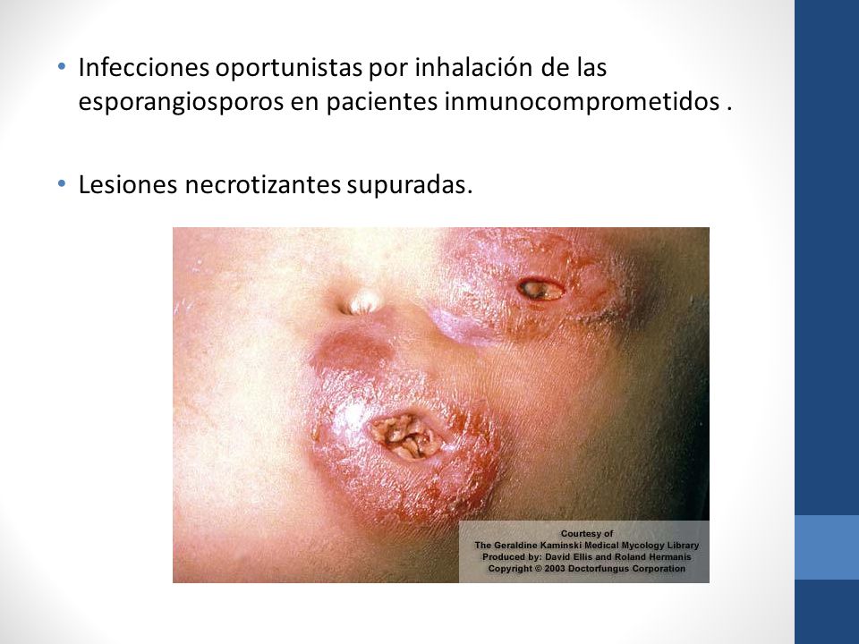 Infecciones oportunistas por inhalación de las esporangiosporos en pacientes inmunocomprometidos .