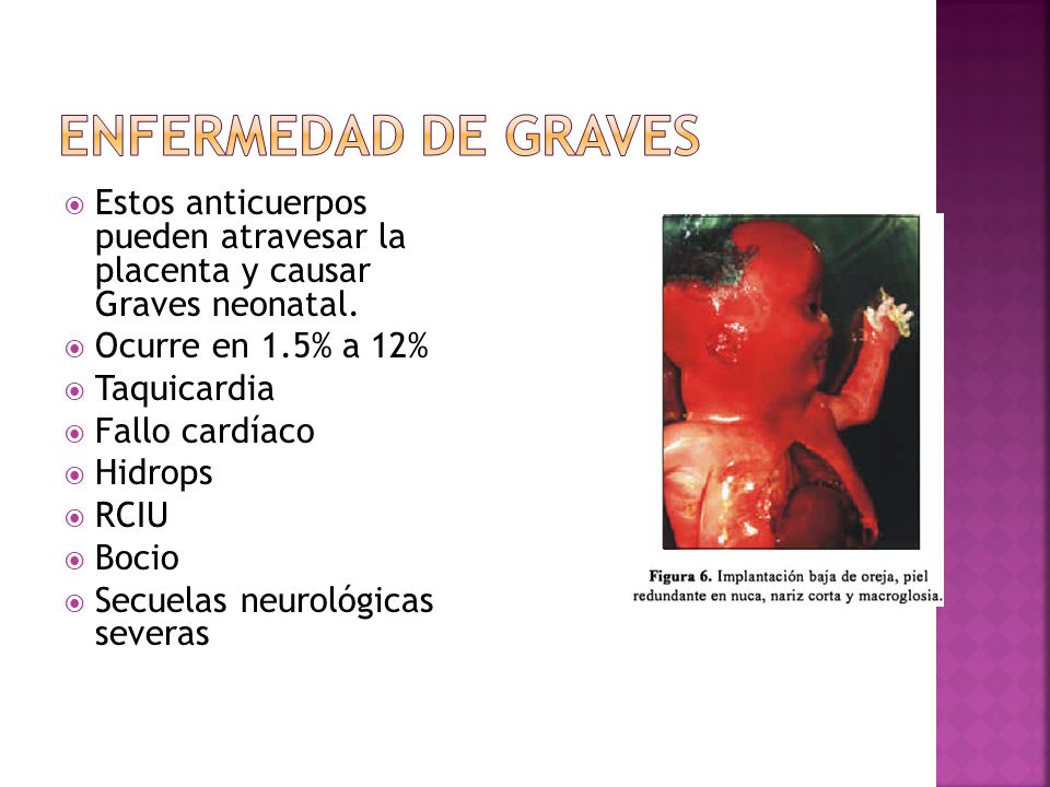 Enfermedad de Graves Estos anticuerpos pueden atravesar la placenta y causar Graves neonatal. Ocurre en 1.5% a 12%