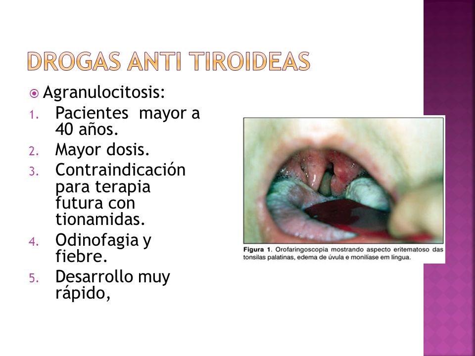 Drogas Anti tiroideas Agranulocitosis: Pacientes mayor a 40 años.