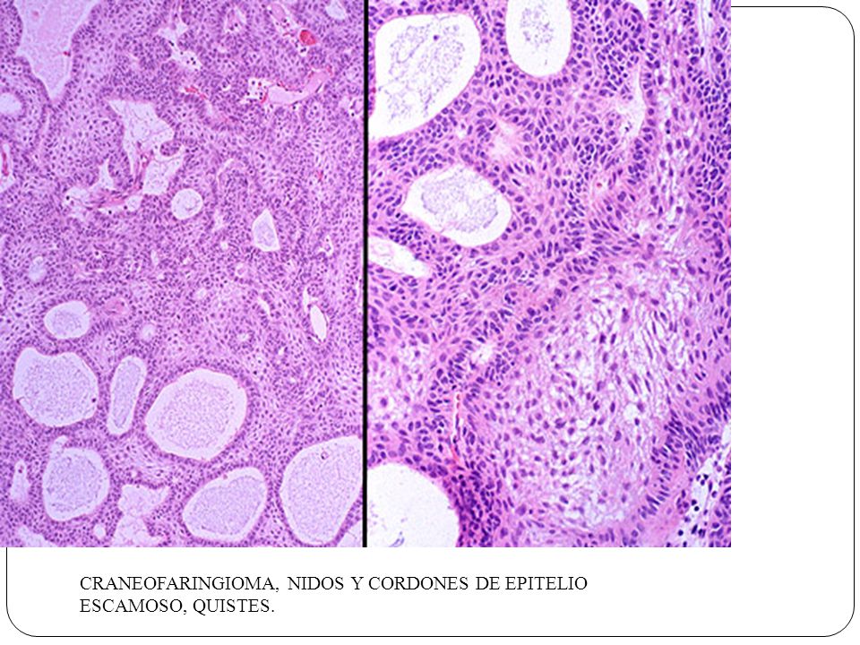 CRANEOFARINGIOMA, NIDOS Y CORDONES DE EPITELIO ESCAMOSO, QUISTES.