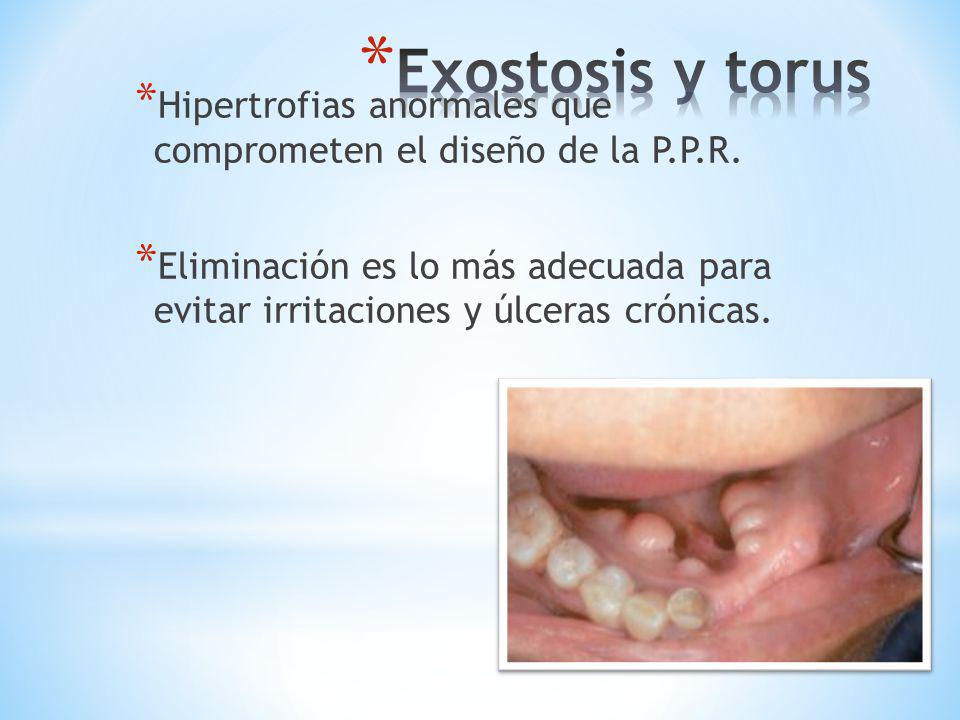 Exostosis y torus Hipertrofias anormales que comprometen el diseño de la P.P.R.