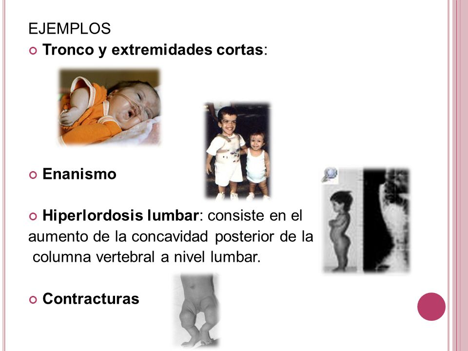EJEMPLOS Tronco y extremidades cortas: Enanismo. Hiperlordosis lumbar: consiste en el. aumento de la concavidad posterior de la.