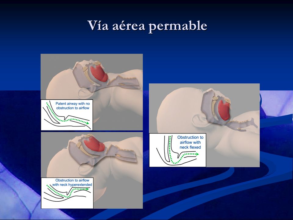 Vía aérea permable The newborn should be placed on his or her back, with the neck slightly extended.