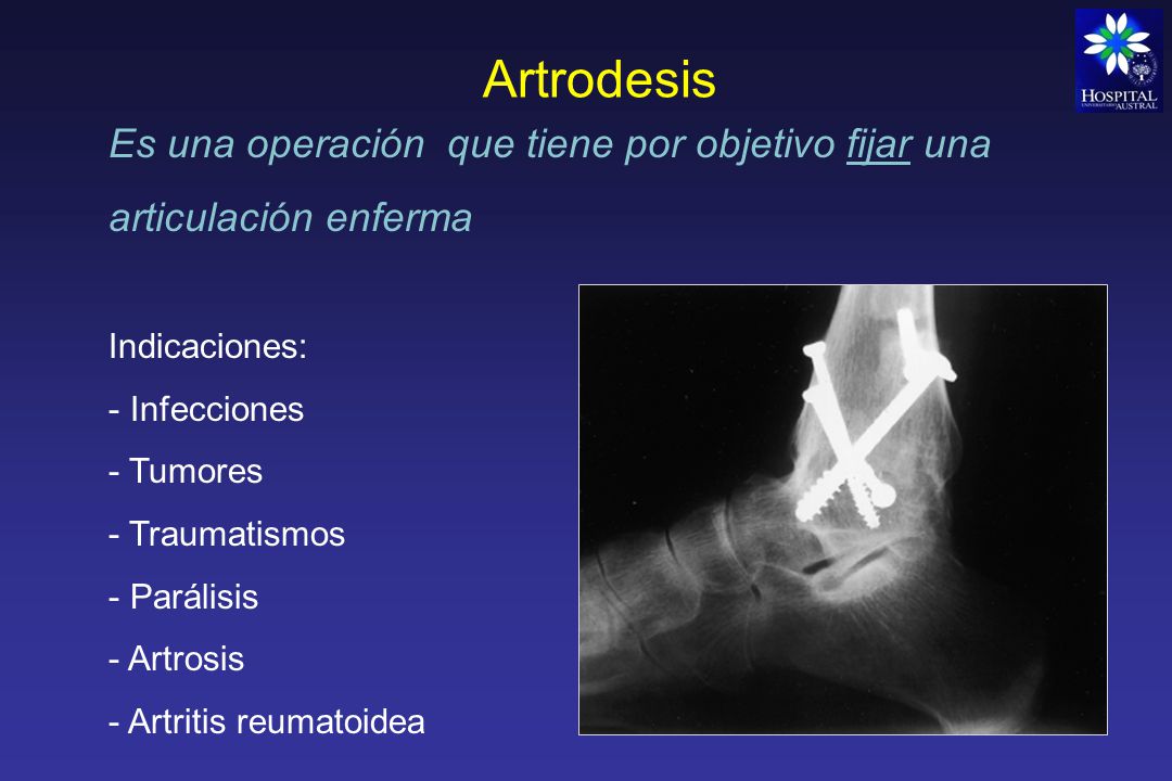 Artrodesis Es una operación que tiene por objetivo fijar una articulación enferma. Indicaciones: Infecciones.