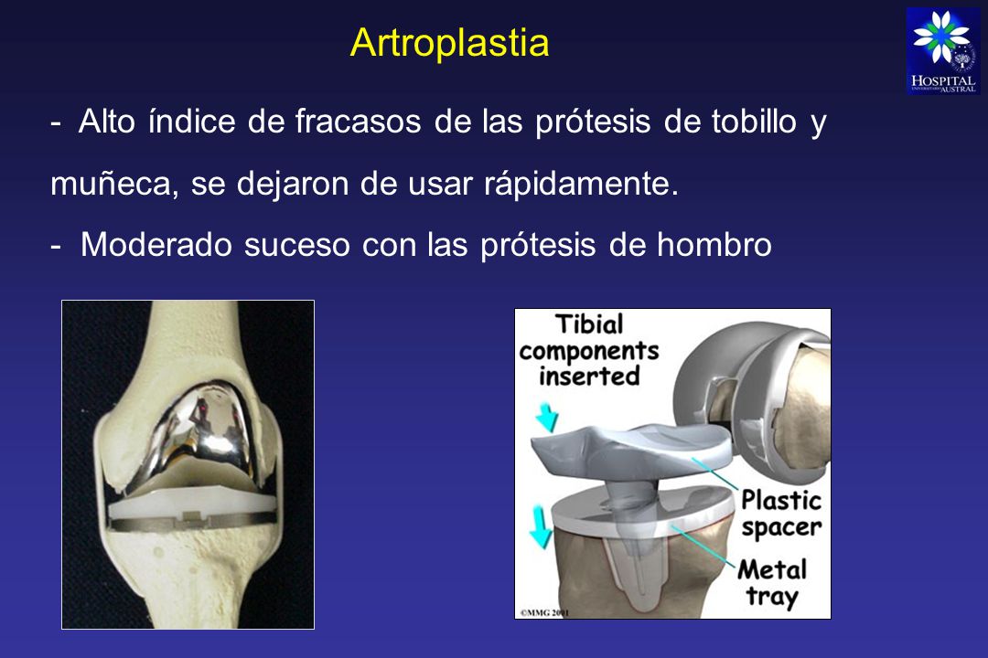 Artroplastia - Alto índice de fracasos de las prótesis de tobillo y muñeca, se dejaron de usar rápidamente.