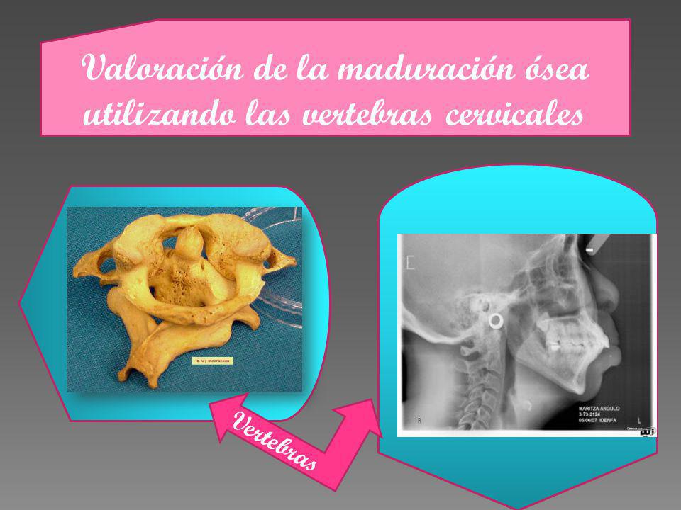 Valoración de la maduración ósea utilizando las vertebras cervicales