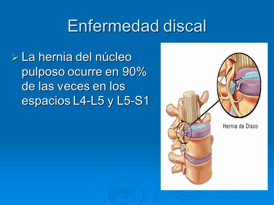 Enfermedad discal La hernia del núcleo pulposo ocurre en 90% de las veces en los espacios L4-L5 y L5-S1.