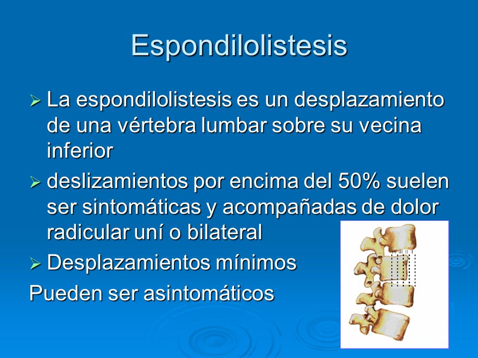 Espondilolistesis La espondilolistesis es un desplazamiento de una vértebra lumbar sobre su vecina inferior.